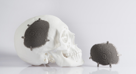 Implant cranien imprimée en 3d métal