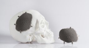 麻省理工学院integrierten Anschraublaschen das gitförmige Implantat am Schädelknochen fixiert.