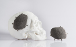 Novax DMA cranial implant built by Protolabs