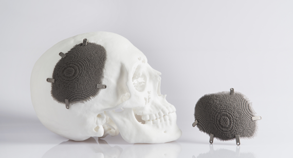 Novax DMA cranial implant